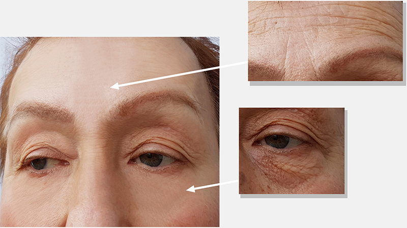 Before and after anti-wrinkle treatment showing smoother forehead lines and reduced under-eye wrinkles