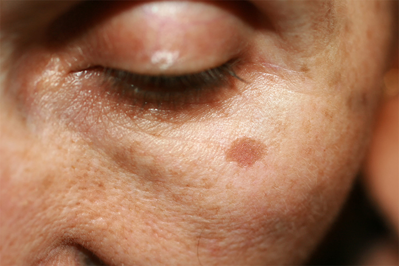Close-up of facial skin with visible sunspot showing pigmentation treatment area