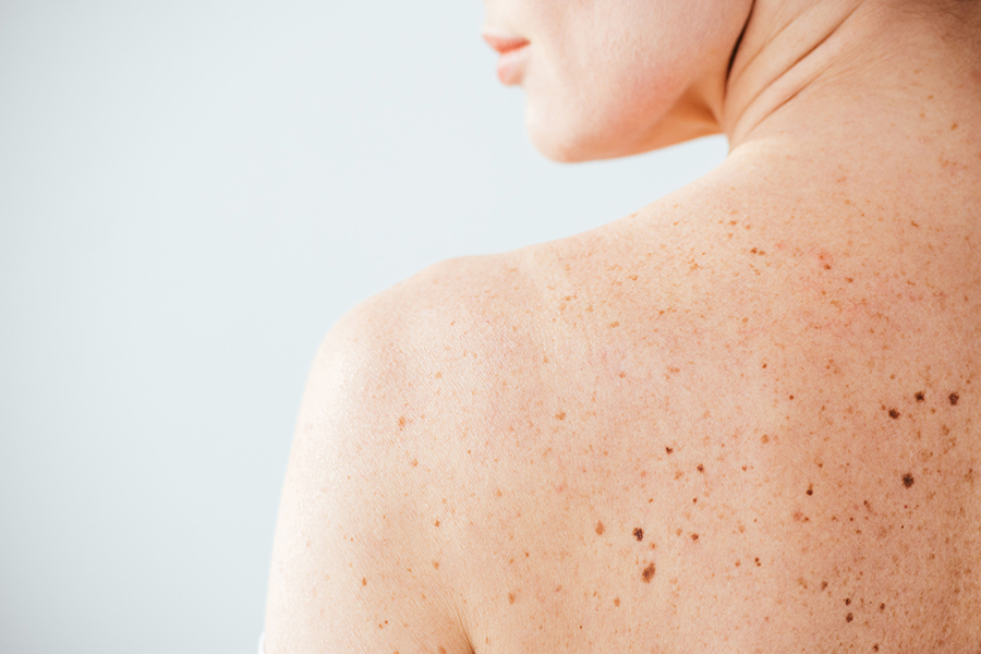 Close-up of skin with freckles and moles highlighting the importance of skin health monitoring and preventative skincare